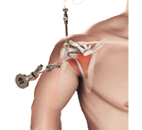 Arthroscopic Rotator Cuff Repair