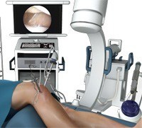 Arthroscopic Reconstruction of the Knee for Ligament Injuries