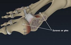 Bunion Surgery or Bunionectomy

