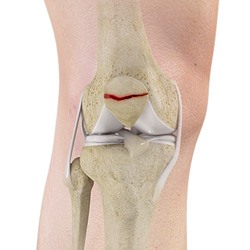 Patella Fracture