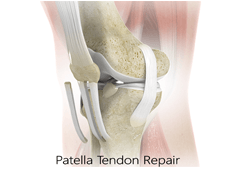 Patellar Tendon Repair

