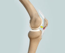 Patellar Tendinitis

