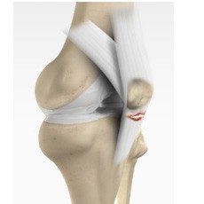 Patella Tendon Rupture