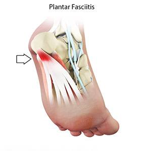 Plantar Fasciitis

