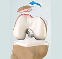 Recurrent Patella Dislocation

