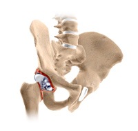 Revision Hip Replacement
