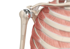 Shoulder Joint Replacement